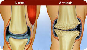 Артроз коленного сустава - Статьи Ортоленд